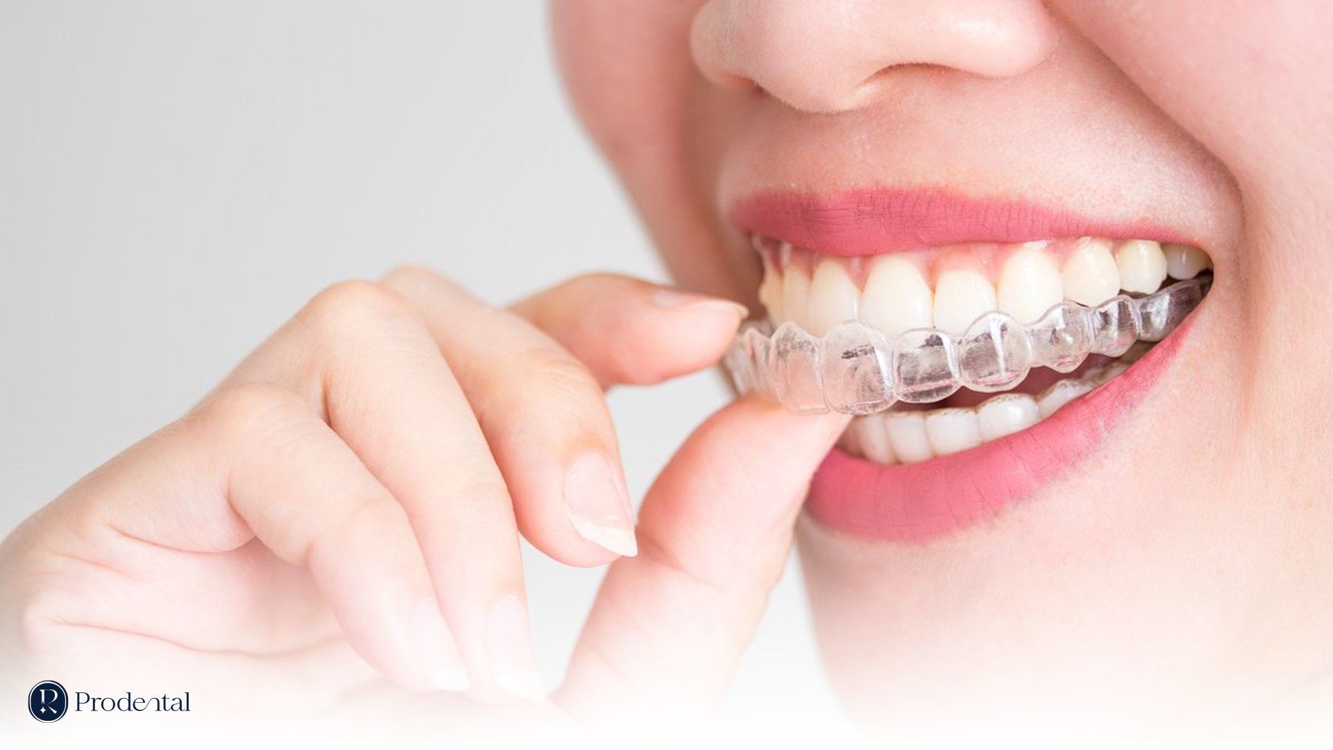 INVISALIGN