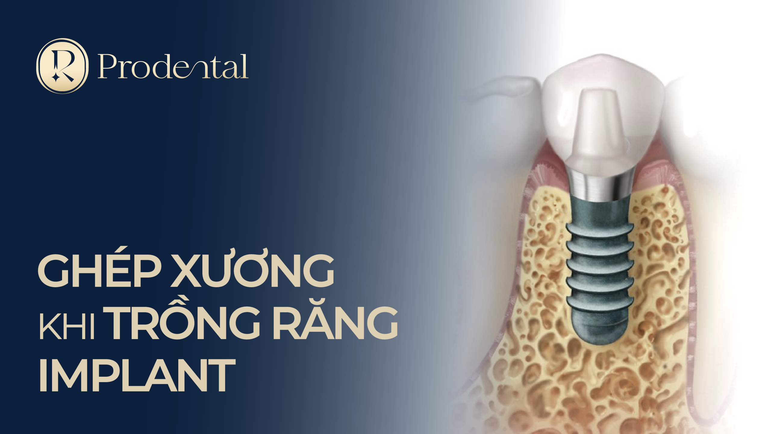 Ghép xương khi trồng răng Implant 04 1 scaled