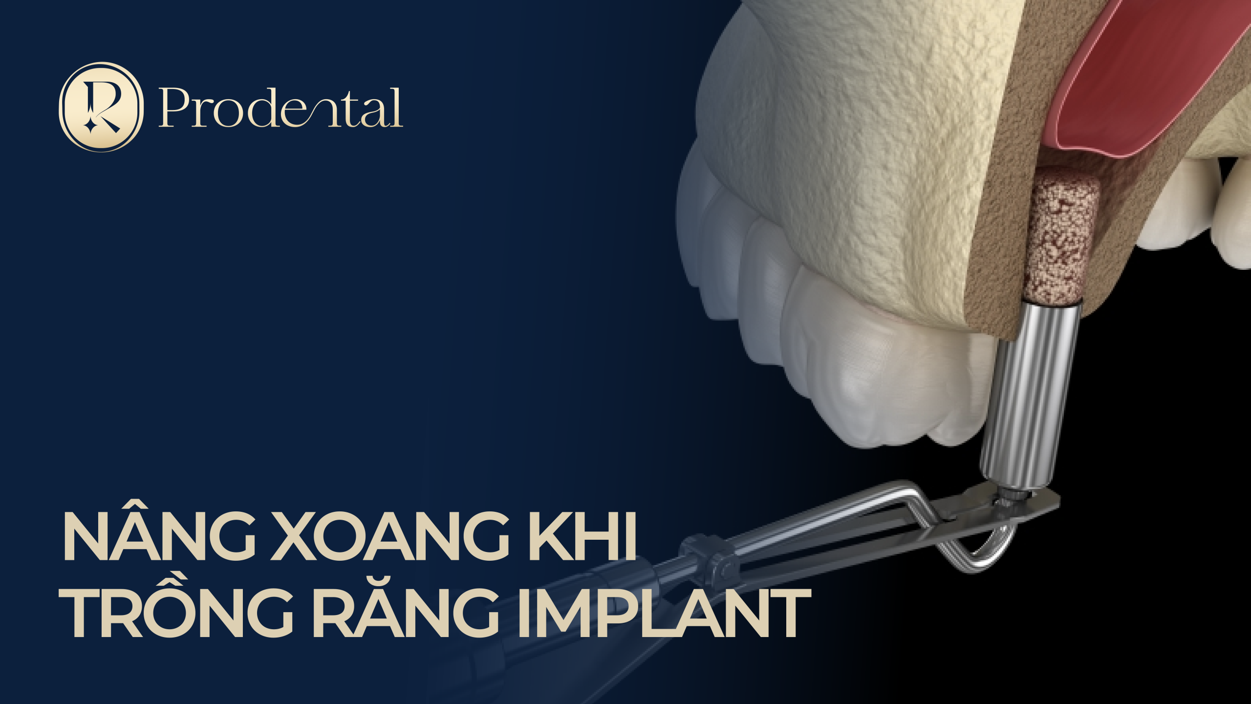 Nâng xoang khi trồng răng Implant1 scaled